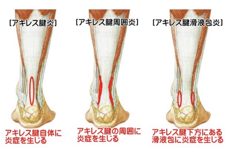 考えられる合併症