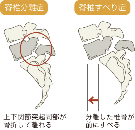 腰椎分離症・すべり症の早期回復と治療｜岡崎市のスポーツ専門パーソナルトレーニング｜メディカルコンディション